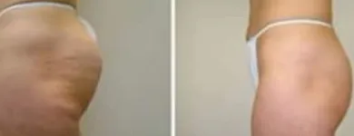 La imagen 3 de la Empresa AINE DEPILACION DEFINITIVA Sistema Español en Capital Federal AR-B